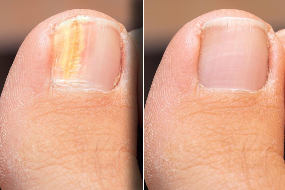 Close-up of infected toenails showing fungus